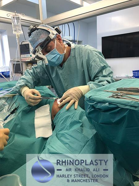 Rhinoplasty Rhinoplasty Manchester, Liverpool & Leeds. Septoplasty, otoplasty, dermal fillers botox. Plastic surgeon