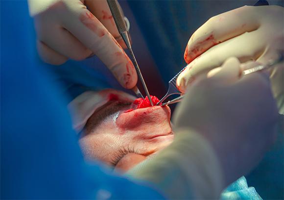 Rhinoplasty Manchester, Liverpool & Leeds. Open rhinoplasty procedure in progress.